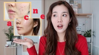 My Honest Experience with Acne Laser Treatment in Korea [upl. by Saks]