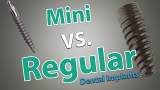 Are Mini Dental Implants a permanent solution [upl. by Morris]