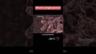 What is Emphysema COPD 🫁 [upl. by Anialad551]