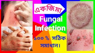 fungal infection eczema dad eczema fungal infection treatment fungal infection in Bengali দাদ। [upl. by Alehcim177]