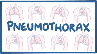 Pneumothorax  causes symptoms diagnosis treatment pathology [upl. by Annerahs]