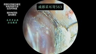 采耳哥Pitched external ear canal debris ｜563 [upl. by Quackenbush219]