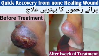 QUICK RECOVERY FROM NONE HEALING WOUND [upl. by Lanna]