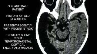 CASE 294 CT BRAIN ENCEPHALOMALACIA [upl. by Truk181]