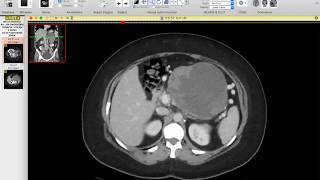 Pancreatic tail mass in young woman Solid pseudopapillary tumor of the pancreas Dr Nelly Tan [upl. by Annoya]