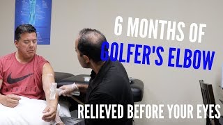 6 Months of Golfers Elbow Relieved Before Your Eyes REAL RESULTS [upl. by Holly509]