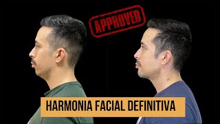 HARMONIA DEFINITIVA DO PERFIL FACIAL [upl. by Bamberger]