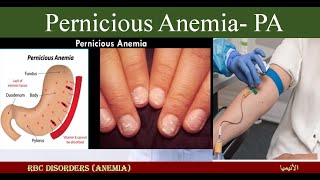 Lecture 15 Pernicious Anemia  PA [upl. by Aira]