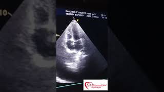 Constrictive pericarditis Echo  CP Echo  Echocardiography toacs  constrictive pericarditis [upl. by Marten]