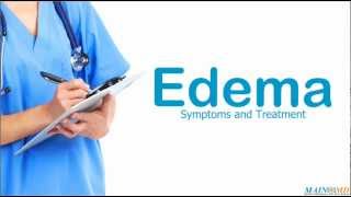 Edema Symptoms and Treatment [upl. by Ivon617]