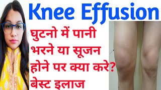 Knee Effusion  घुटने में पानी भरनासूजन का इलाज  Knee Effusion Causes And Treatment  Swollen Knee [upl. by Willner]