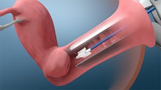 Pruebas de Papanicolaou y VPH [upl. by Ymas]