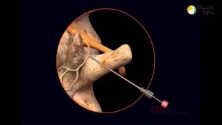 Lumbar Radiofrequency Ablation Procedure [upl. by Cariotta629]