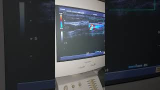 carotid bulb carotid Artery Doppler ultrasound [upl. by Peggy]