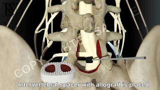 Dr Gillard lectures on How to Read Your Lumbar MRI [upl. by Ches923]