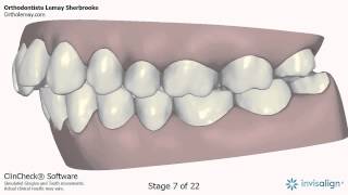 Invisalign Clincheck adulte Orthodontiste Lemay Sherbrooke NM48 143234 [upl. by Eecyac]