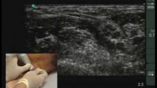 Anaesthesia CME  How to do a Ultrasound Guided Interscalene Block [upl. by Bortman527]