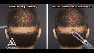 NeoGraft hair transplant procedure  animation [upl. by Lowell]