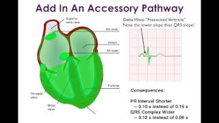 WolffParkinsonWhite WPW and Associated Arrhythmias [upl. by Oirad]