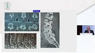 Osteoid Osteoma What Shall I Do by Dr Mohamed Fawzy Khattab [upl. by Atalanti657]