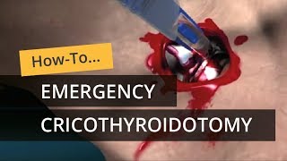 Emergency Cricothyroidotomy using CricKey [upl. by Hanus]