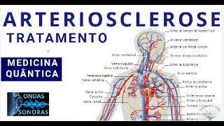 160 ARTERIOSCLEROSE Frequência para o alívio da arteriosclerose [upl. by Annad]