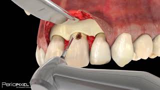 Avance vídeo completo quotCaries Subgingivalquot  PerioPixel [upl. by Dann701]