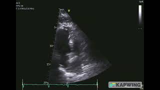 Lipomatous Hypertrophy of Atrial Septum Echo Images [upl. by Rihana355]