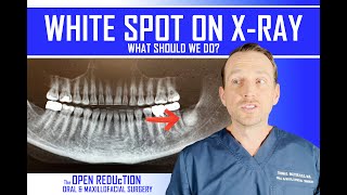 What is the WHITE SPOT on this XRAY How to Evaluate a RADIOPAQUE Lesion  OMFS  Oral Path [upl. by Larok54]