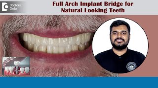 4 or 6 Implants for Full Arch Implant Bridge for Missing TeethDr Parikshith H M  Doctors’ Circle [upl. by Shanney]