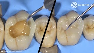 Step by Step Dental Filling Cavity Filling  Tooth Filling Cusp BuildUp of a Molar [upl. by Rollo45]