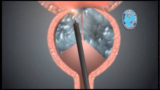 HoLEP  Holmium Laser Enucleation of The Prostate  HoLEP [upl. by Zwiebel]