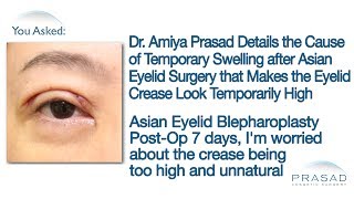 Why Temporary Swelling Concentrates in the Upper Eyelids after Asian Double Eyelid Surgery [upl. by Baudelaire]