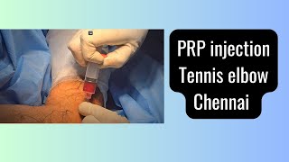 PRP injection of Tennis elbow [upl. by Hadria]