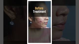 Acne Correction Treatment at The Eden Aestheticsskinandhaircare acne acnetreatment vizag [upl. by Ardith]