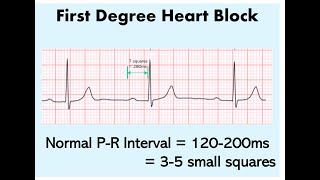 ECG Basics Bradyarrhythmias [upl. by Niamrahc]