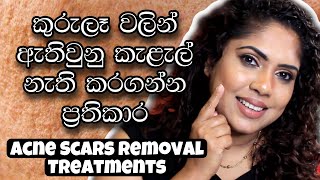 TREATMENTS FOR ACNE SCARS  ALL ABOUT ACNE SCARS  SINHALA BEAUTY TIPS 2021 [upl. by Conger]