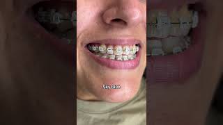 Braces Colors Before and After 8 weeks [upl. by Johm]