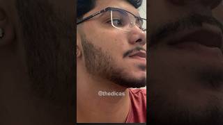 RESULTADO COM MINOXIDIL 11 meses de tratamento minoxidil barba thedicas [upl. by Harrak534]