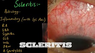 SCLERITIS in easiest way  Part 1 [upl. by Ear327]