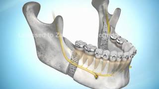 Avanço de Mandíbula  Osteotomia Sagital [upl. by Artenra]