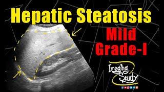 Mild Hepatic Steatosis  Mild Fatty Infiltration  Ultrasound  Case 170 [upl. by Montanez]