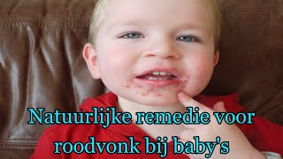 Natuurlijke remedie voor roodvonk bij babys [upl. by Hochman649]