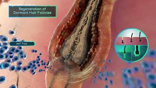 Human Smart Exosomes in action  Regenera Activa Autologous Micrografting Hair Treatment [upl. by Leena]