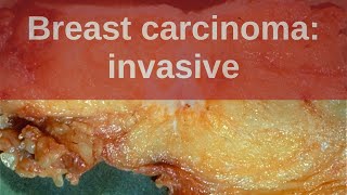 Breast Carcinoma Invasive  Pathology mini tutorial [upl. by Htebzile]