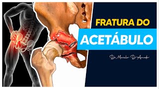 TUDO O QUE VOCÊ PRECISA SABER SOBRE FRATURA DO ACETÁBULO  TRATAMENTO E RECUPERAÇÃO [upl. by Lahpos]