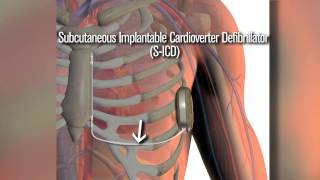 New SICD defibrillator a safety net for cardiac patients [upl. by Ellenaej446]