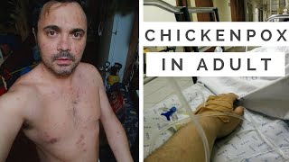 CHICKENPOX IN ADULT  Varicella my experience [upl. by Aeli]