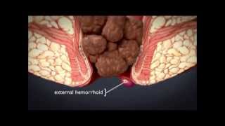 HEMORRHOiDS  What are hemorrhoids  What is the treatment for hemorrhoids [upl. by Franck]