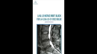 Nerve Root Block  Non Surgical Treatment for Back Pain [upl. by Acissaj]